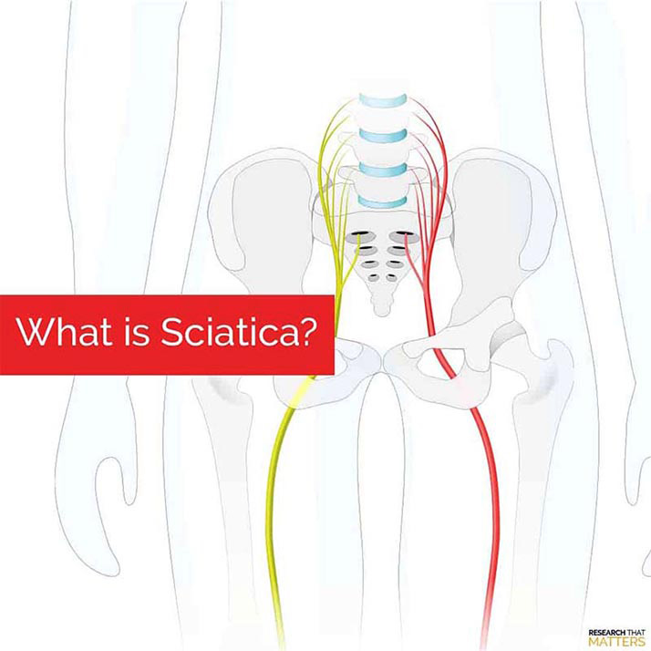Chiropractic Georgetown ON What Is Sciatica