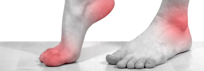 Chiropractic Georgetown ON plantar fasciitis